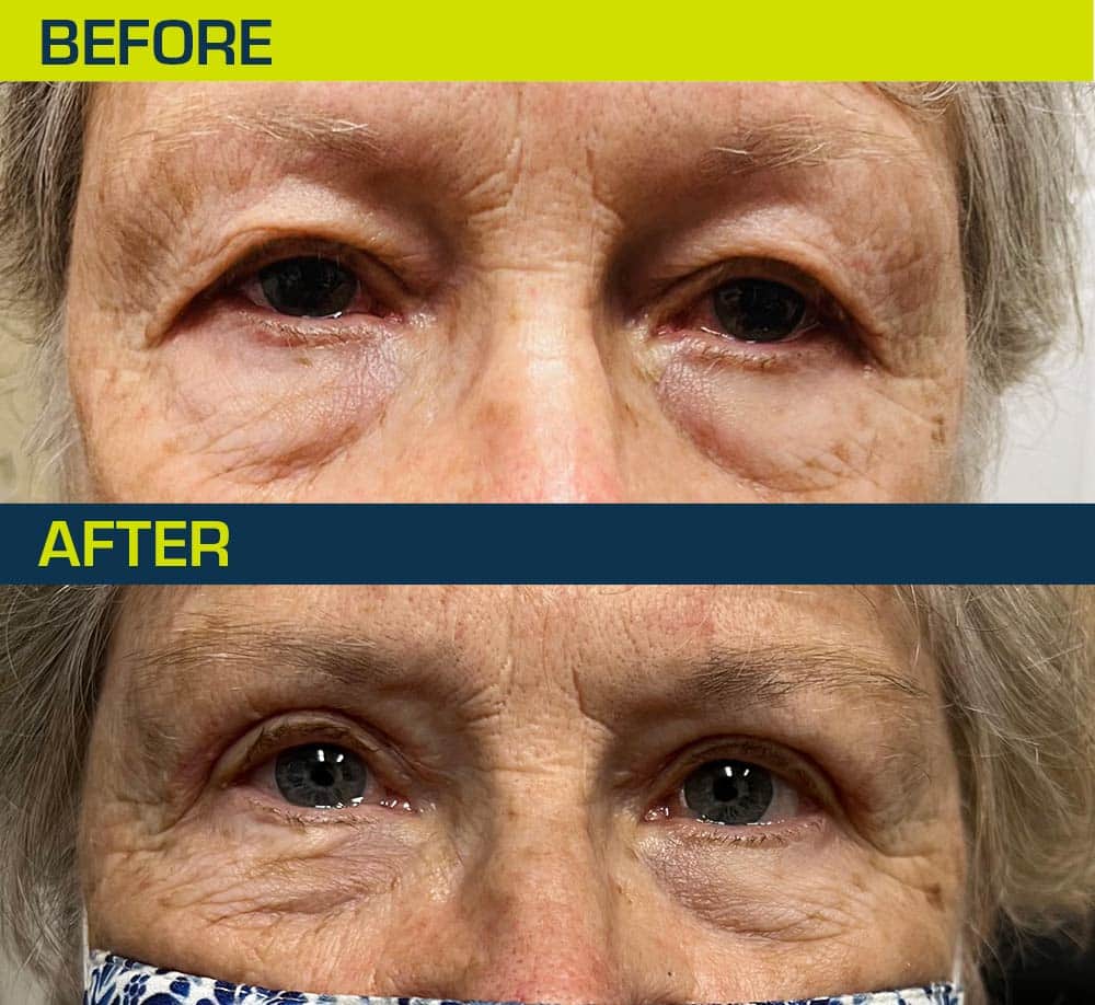 Under Eye Bags/Tired Eyes - Steele Dermatology Atlanta Alpharetta Georgia