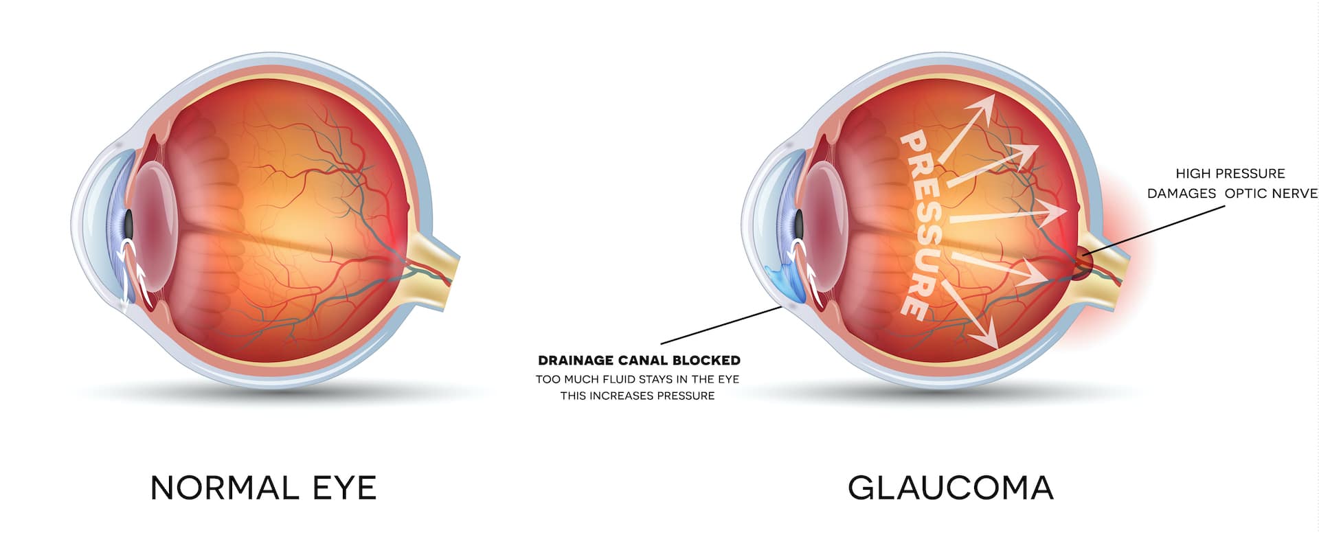 congenital glaucoma diagram