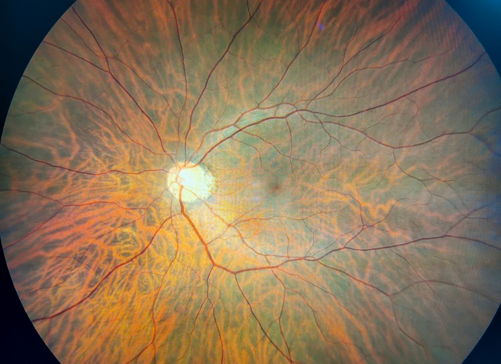 Retina Test, Fundus Checkup, Dilated test, Diabetes in retina